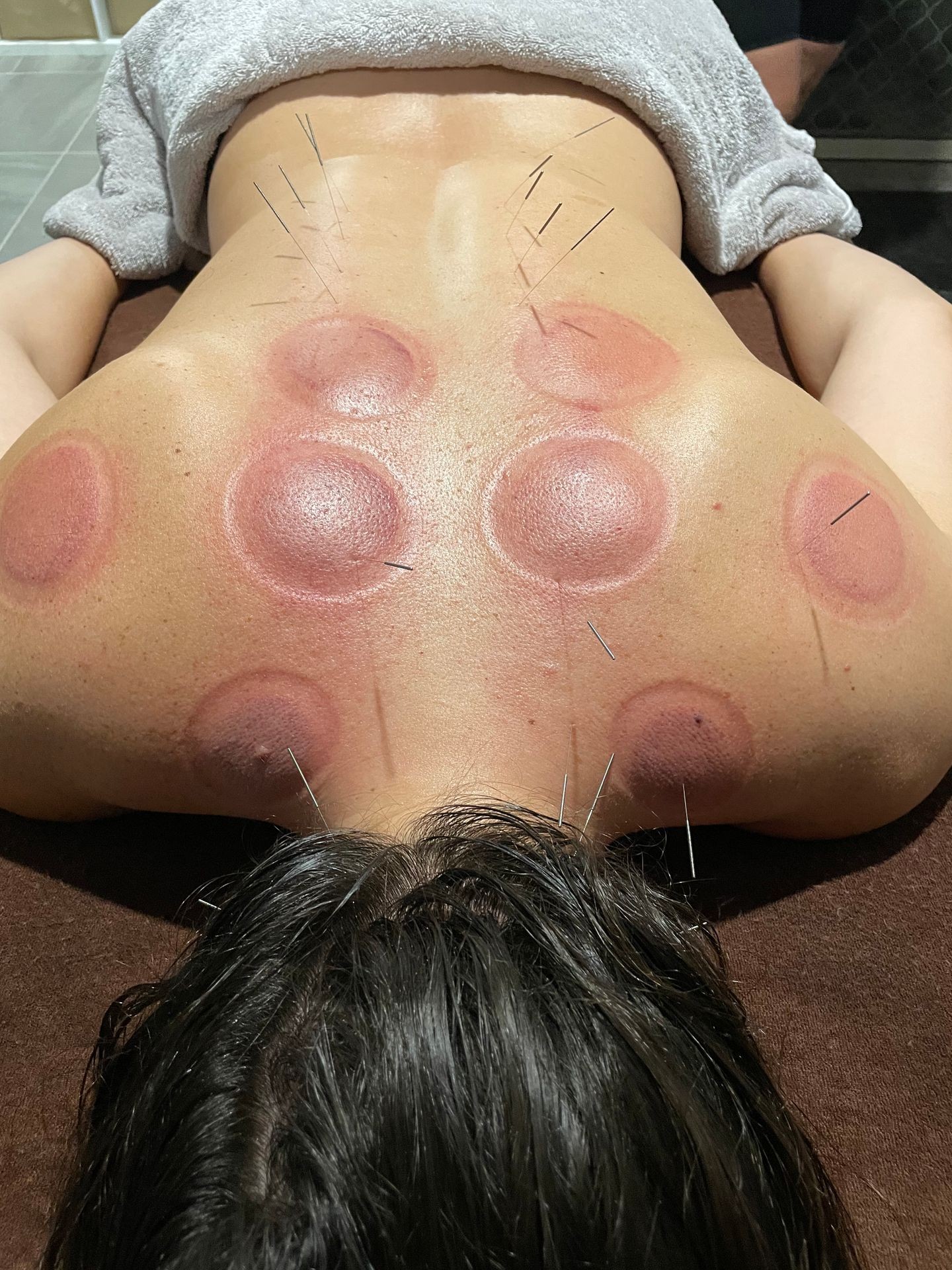 A red back with acupunture needles in it after cupping, acupuncture cupping. 